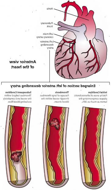 Koronar trombose (hjerteinfarkt). koronar eksamen. Koronar trombose (hjerteinfarkt). koronar eksamen.