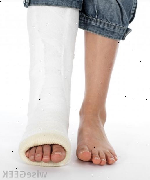 Brukket ankel - åpen reduksjon og fiksering. leter etter et plaster cast. Brukket ankel - åpen reduksjon og fiksering. leter etter et plaster cast.
