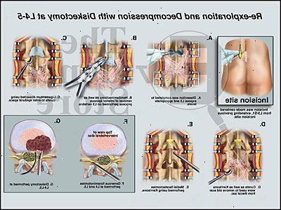 Discectomy - skiveprolaps. etter andndash; på sykehus. Discectomy - skiveprolaps. etter andndash; på sykehus.