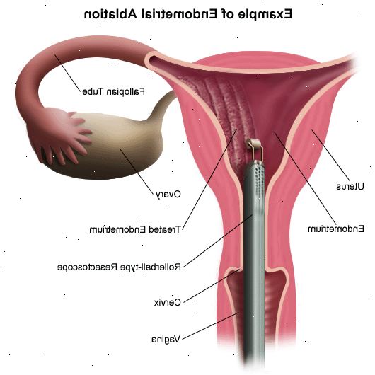Endometrial ablasjon. etter andndash; på sykehus. Endometrial ablasjon. etter andndash; på sykehus.