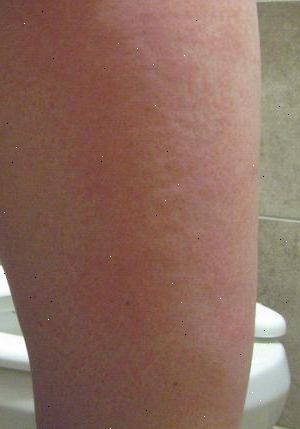 Soleksem (solar dermatitt). hva er symptomene på soleksem? Soleksem (solar dermatitt). hva er symptomene på soleksem?
