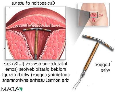 Contraceptive spoler (IUDs). hvor godt de beskytter deg mot graviditet? Contraceptive spoler (IUDs). hvor godt de beskytter deg mot graviditet?