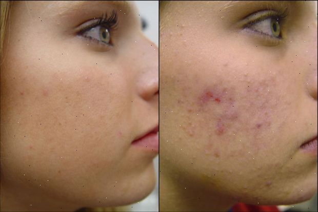 Acne. hva er symptomene? Acne. hva er symptomene?