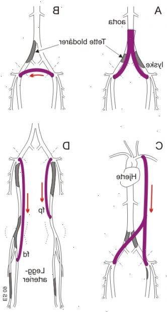 Femoro-femoral bypass. etter andndash; på sykehus. Femoro-femoral bypass. etter andndash; på sykehus.