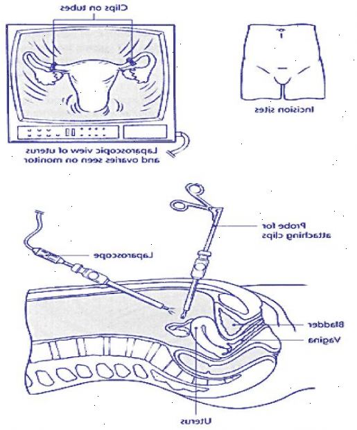 Sterilisering for kvinner. er sterilisering populær? Sterilisering for kvinner. er sterilisering populær?