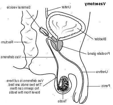 Vasektomi (sterilisering for menn). som kan ha en vasektomi? Vasektomi (sterilisering for menn). som kan ha en vasektomi?