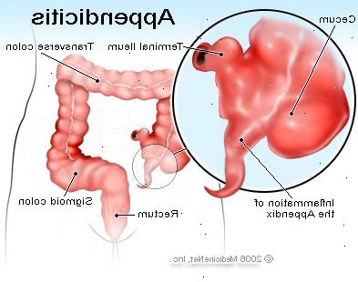Blindtarmbetennelse. hva er blindtarmbetennelse? Blindtarmbetennelse. hva er blindtarmbetennelse?