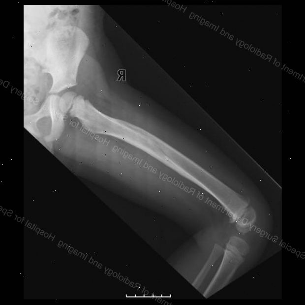 Brudd på lårbenet - femur (i et barn). etter andndash; på sykehus. Brudd på lårbenet - femur (i et barn). etter andndash; på sykehus.
