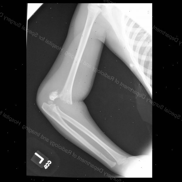 Brudd av overarmen - humerus. etter andndash; på sykehus. Brudd av overarmen - humerus. etter andndash; på sykehus.