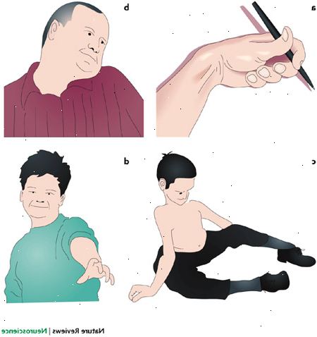 Dystoni. dyp hjernestimulering. Dystoni. dyp hjernestimulering.
