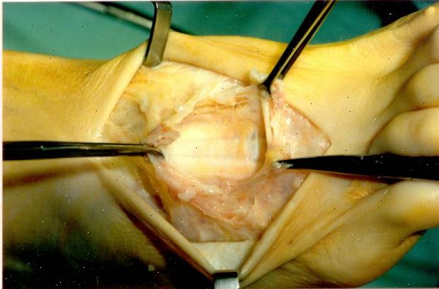 Ganglion excision - fots. etter andndash; på sykehus. Ganglion excision - fots. etter andndash; på sykehus.