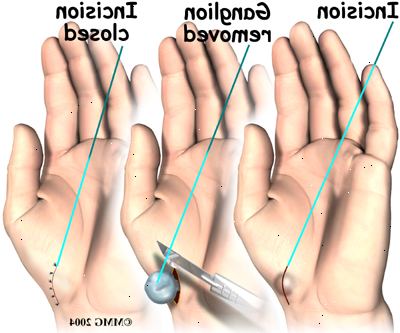 Ganglion excision - håndleddet. etter andndash; på sykehus. Ganglion excision - håndleddet. etter andndash; på sykehus.