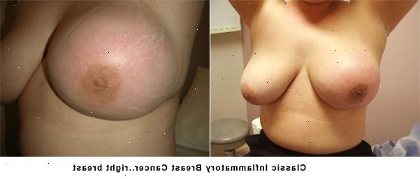 Bryst betennelse. hva er bryst betennelse? Bryst betennelse. hva er bryst betennelse?