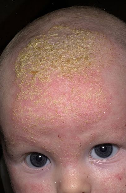 Cradle cap (infantile seborreisk dermatitt). hva er symptomene? Cradle cap (infantile seborreisk dermatitt). hva er symptomene?