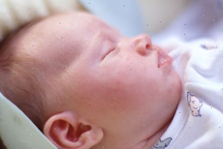 Infantile eksem. hva er infantile eksem? Infantile eksem. hva er infantile eksem?