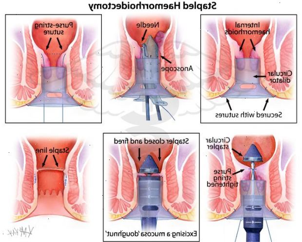 Haemorrhoidectomy. etter andndash; på sykehus. Haemorrhoidectomy. etter andndash; på sykehus.