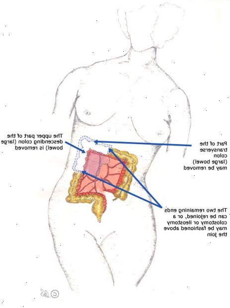 Hemi-colectomy - igjen. etter andndash; på sykehus. Hemi-colectomy - igjen. etter andndash; på sykehus.