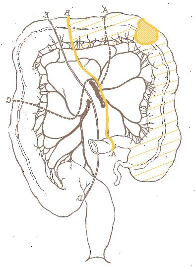 Hemi-colectomy - høyre. etter andndash; på sykehus. Hemi-colectomy - høyre. etter andndash; på sykehus.