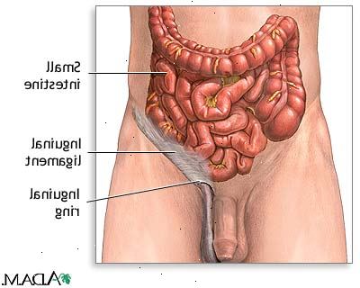 Brokk reparasjon inguinal. etter andndash; på sykehus. Brokk reparasjon inguinal. etter andndash; på sykehus.