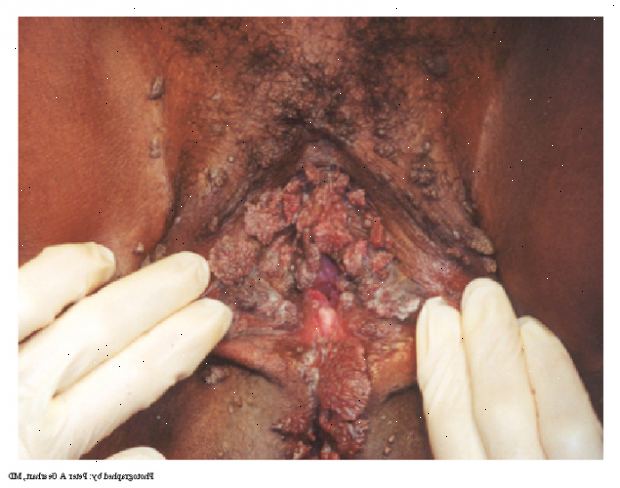 Klamydia. er det noen symptomer? Klamydia. er det noen symptomer?