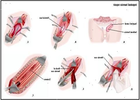 Brokk reparasjon - inguinal (barn). etter andndash; på sykehus. Brokk reparasjon - inguinal (barn). etter andndash; på sykehus.