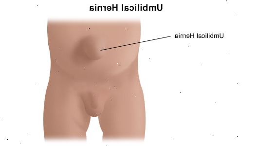 Brokk reparasjon - umbilical (barn). etter andndash; på sykehus. Brokk reparasjon - umbilical (barn). etter andndash; på sykehus.