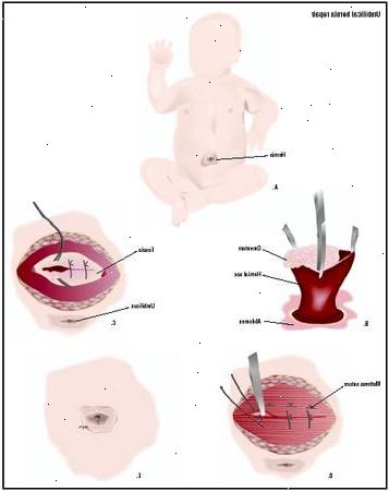 Brokk reparasjon umbilical. etter andndash; på sykehus. Brokk reparasjon umbilical. etter andndash; på sykehus.