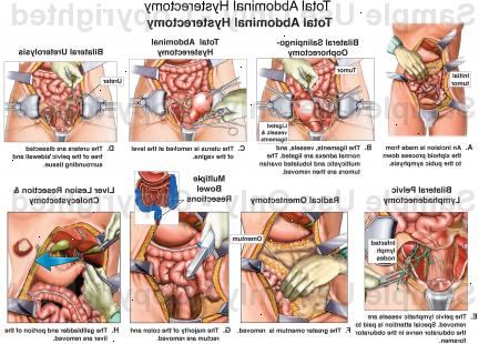Hysterektomi - abdominal. etter andndash; på sykehus. Hysterektomi - abdominal. etter andndash; på sykehus.