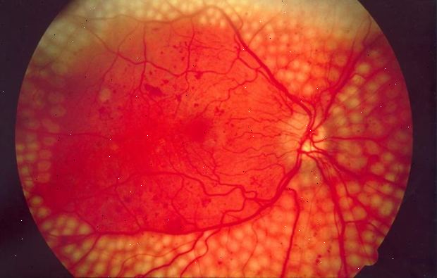 Laser behandling for diabetisk retinopati. etter andndash; på sykehus. Laser behandling for diabetisk retinopati. etter andndash; på sykehus.