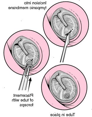 Myringotomy. etter andndash; på sykehus. Myringotomy. etter andndash; på sykehus.