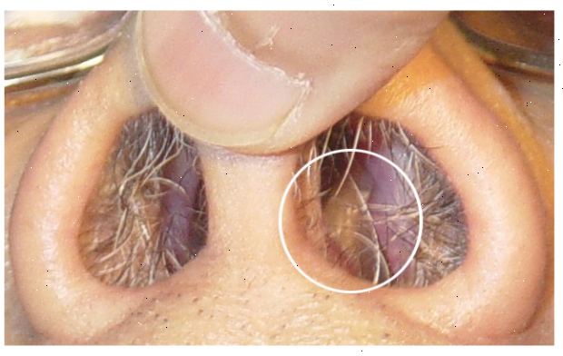 Nasal polypp fjerning. etter andndash; på sykehus. Nasal polypp fjerning. etter andndash; på sykehus.