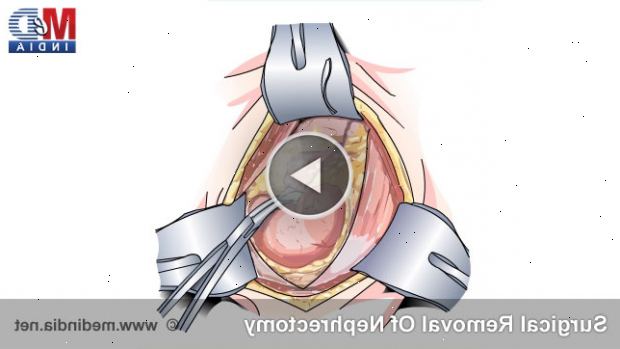 Nephrectomy - nyre fjerning. etter andndash; på sykehus. Nephrectomy - nyre fjerning. etter andndash; på sykehus.