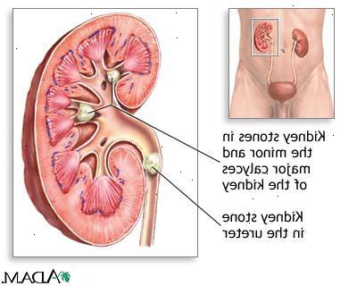 Nephrolithotomy - fjerning av nyrestein. etter andndash; på sykehus. Nephrolithotomy - fjerning av nyrestein. etter andndash; på sykehus.
