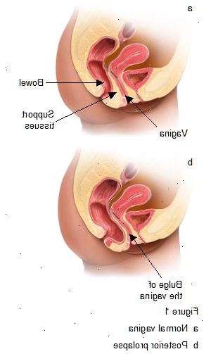 Posterior reparasjon - prolaps operasjon. etter andndash; på sykehus. Posterior reparasjon - prolaps operasjon. etter andndash; på sykehus.