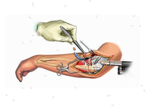 Radius og ulna brudd - intern fiksering. etter andndash; på sykehus. Radius og ulna brudd - intern fiksering. etter andndash; på sykehus.