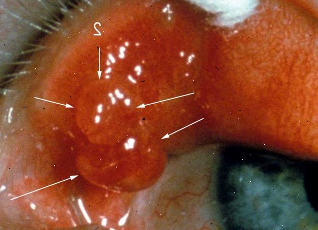 Fjerning av chalazion. etter andndash; på sykehus. Fjerning av chalazion. etter andndash; på sykehus.