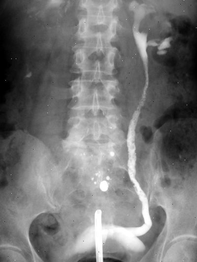 Retrograde pyelogram. etter andndash; på sykehus. Retrograde pyelogram. etter andndash; på sykehus.
