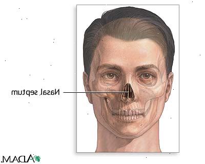 Septoplasty. etter andndash; på sykehus. Septoplasty. etter andndash; på sykehus.