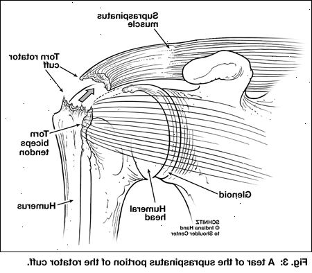 Skulder sene reparasjon - rotator cuff. etter andndash; på sykehus. Skulder sene reparasjon - rotator cuff. etter andndash; på sykehus.
