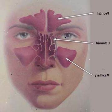 Sinus utvasking. etter andndash; på sykehus. Sinus utvasking. etter andndash; på sykehus.