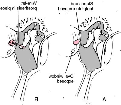 Stapedectomy. etter andndash; på sykehus. Stapedectomy. etter andndash; på sykehus.