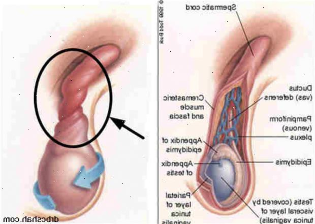 Testis fiksering - vridning. etter andndash; på sykehus. Testis fiksering - vridning. etter andndash; på sykehus.