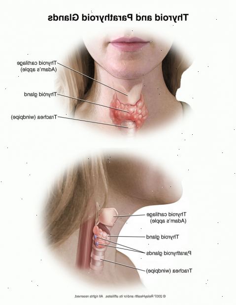 Thyroidectomy. etter andndash; på sykehus. Thyroidectomy. etter andndash; på sykehus.