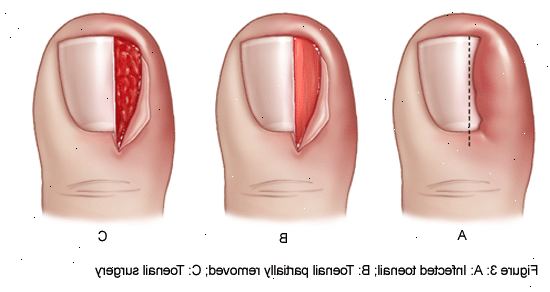 Toe nail fjerning. etter andndash; på sykehus. Toe nail fjerning. etter andndash; på sykehus.