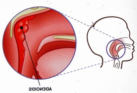 Mandlene og adenoidectomy - barn. etter andndash; på sykehus. Mandlene og adenoidectomy - barn. etter andndash; på sykehus.