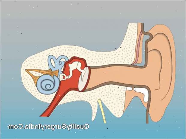 Tympanoplasty - myringoplasty (voksen). etter andndash; på sykehus. Tympanoplasty - myringoplasty (voksen). etter andndash; på sykehus.