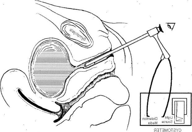 Urethroscopy. etter andndash; på sykehus. Urethroscopy. etter andndash; på sykehus.
