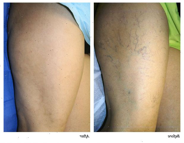 Varicose vein fjerning. etter andndash; på sykehus. Varicose vein fjerning. etter andndash; på sykehus.