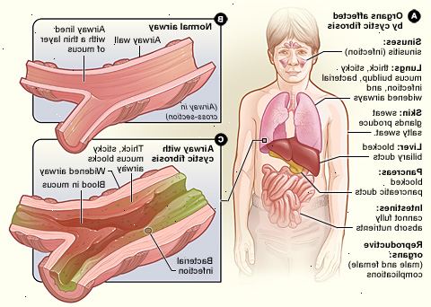 Cystisk fibrose. hva er cystisk fibrose? Cystisk fibrose. hva er cystisk fibrose?