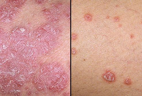 Psoriasis. hva som forårsaker psoriasis? Psoriasis. hva som forårsaker psoriasis?